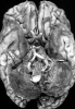 Multiple cavernous  malformations, familial, with superficial siderrhosis